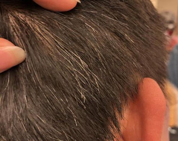 什么是營養(yǎng)性灰白發(fā)？